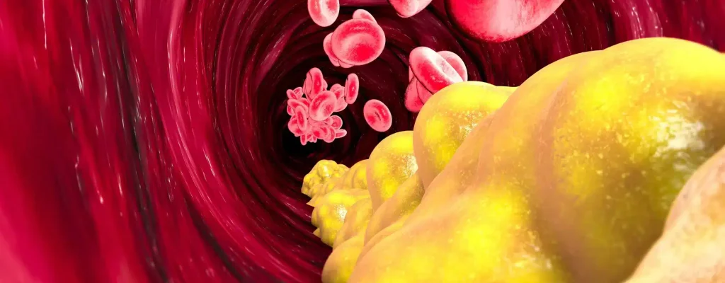 Mécanisme de formation d’une plaque d’athérome